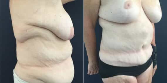 mommy makeover colombia 322-3-min