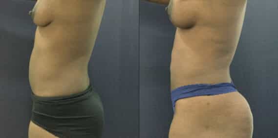 mommy makeover colombia 343-3