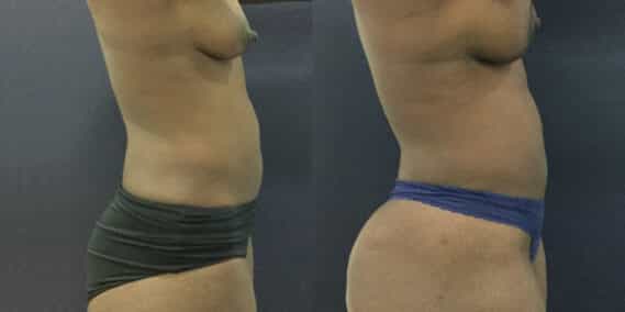 mommy makeover colombia 343-5