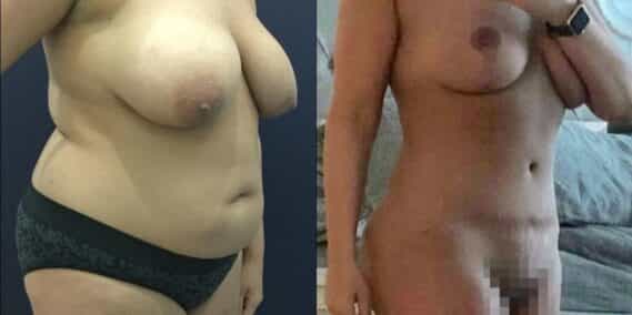 mommy makeover colombia 349-1