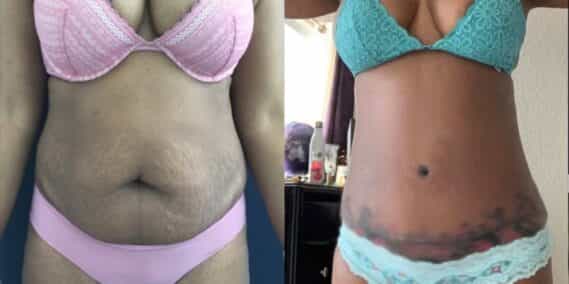 mommy makeover colombia 355-1