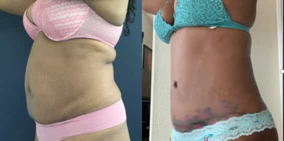 mommy makeover colombia 355-2