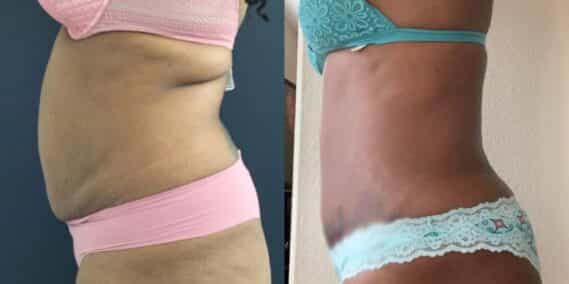 mommy makeover colombia 355-3