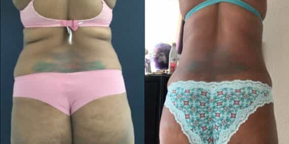 mommy makeover colombia 355-4