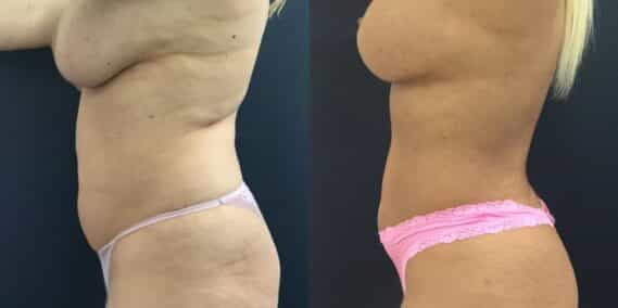 mommy makeover colombia 358-2