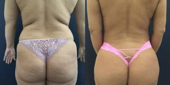 mommy makeover colombia 358-4