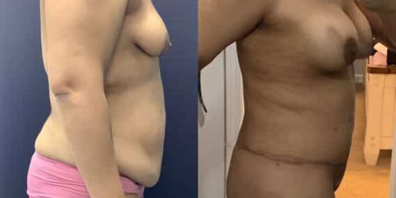mommy makeover colombia 360-2