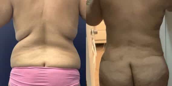 mommy makeover colombia 360-4