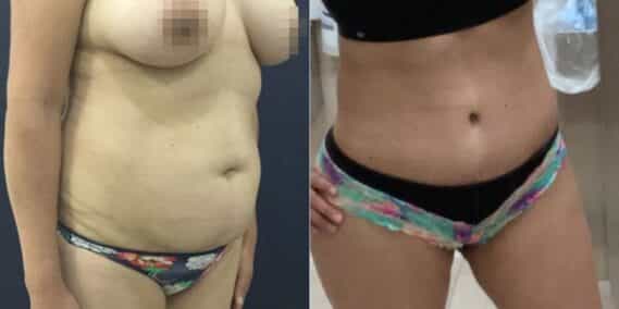 mommy makeover colombia 361-2
