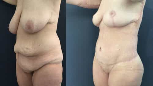 posterior body lift colombia 226-2