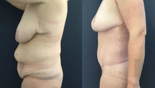 posterior body lift colombia 226-3