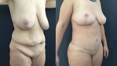 posterior body lift colombia 226-4