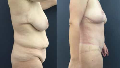 posterior body lift colombia 226-5