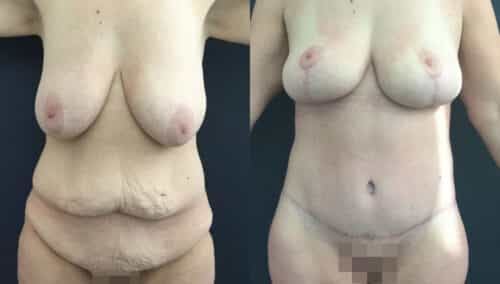 posterior body lift colombia 226-7