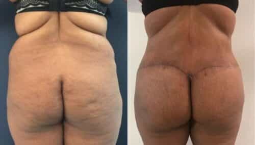 posterior body lift colombia 263-1