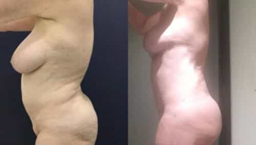 posterior body lift colombia 282-2
