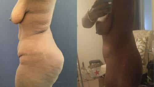 posterior body lift colombia 298-2