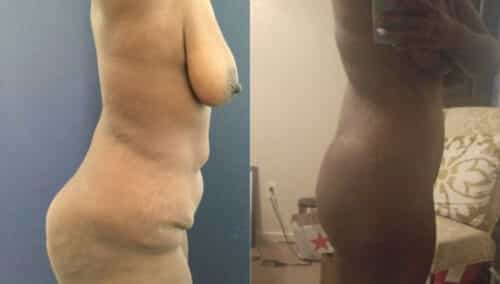 posterior body lift colombia 298-3