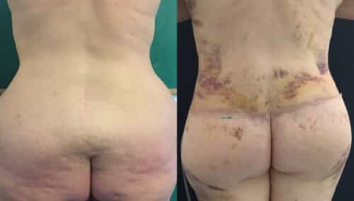 posterior body lift colombia 336-1