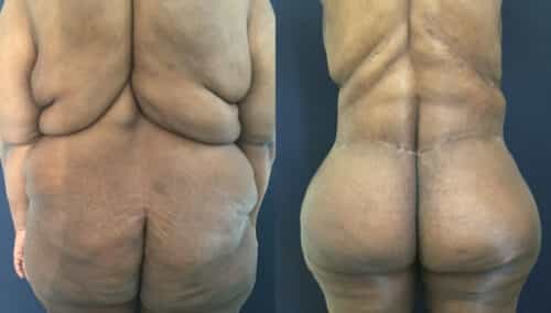 posterior body lift colombia 337-1