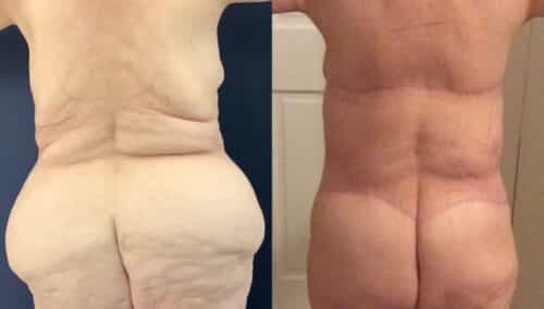 posterior body lift colombia 368-1