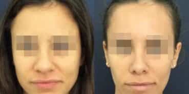 rhinoplasty colombia 212-1