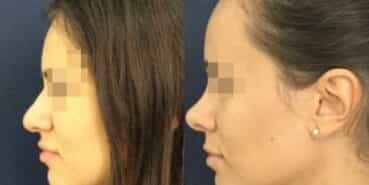 rhinoplasty colombia 212-3