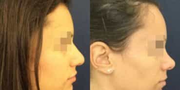 rhinoplasty colombia 212-z (1)