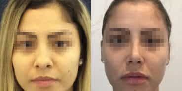 rhinoplasty colombia 225-1