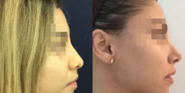 rhinoplasty colombia 225-2