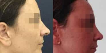 rhinoplasty colombia 232-2