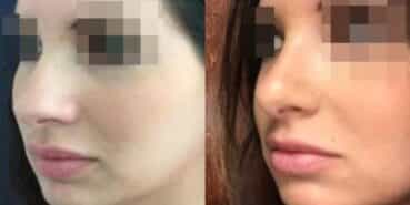 rhinoplasty colombia 235-2