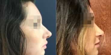 rhinoplasty colombia 235-5