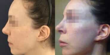 rhinoplasty colombia 240-3