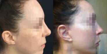 rhinoplasty colombia 240-5