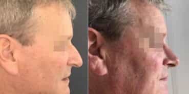 rhinoplasty colombia 256-2-min