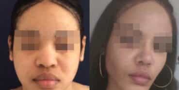 rhinoplasty colombia 267-2-min