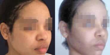 rhinoplasty colombia 267-3-min