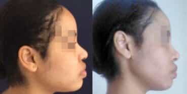 rhinoplasty colombia 267-4-min