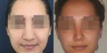 rhinoplasty colombia 278-1-min