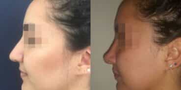 rhinoplasty colombia 278-2-min