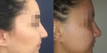 rhinoplasty colombia 278-3-min