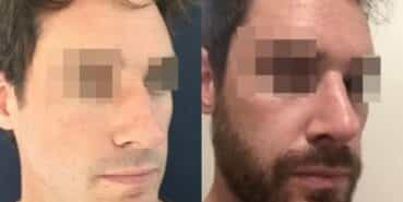 rhinoplasty colombia 295-2-min