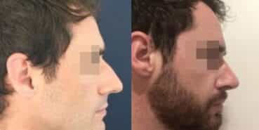 rhinoplasty colombia 295-3-min