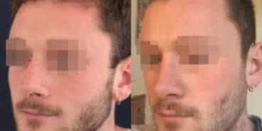 rhinoplasty colombia 296-2-min