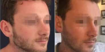 rhinoplasty colombia 296-4-min