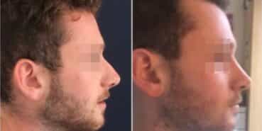 rhinoplasty colombia 296-5-min