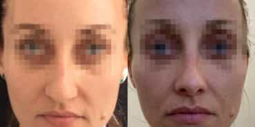 rhinoplasty colombia 321-1-min