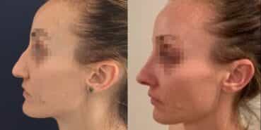 rhinoplasty colombia 321-2-min