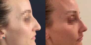 rhinoplasty colombia 321-3-min